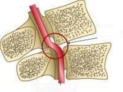 Vail զարկերակի համախտանիշ
