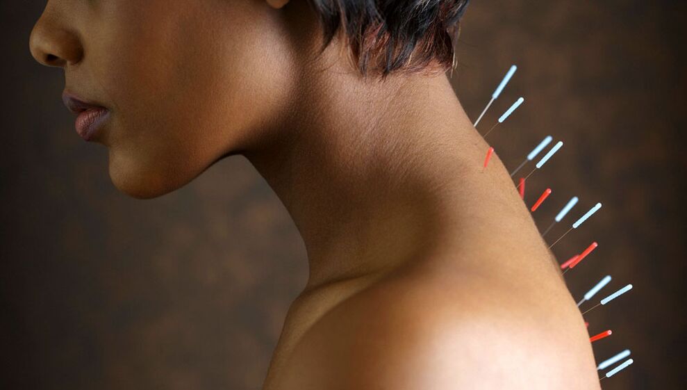 Ասեղնաբուժություն արգանդի վզիկի օստեոխոնդրոզով