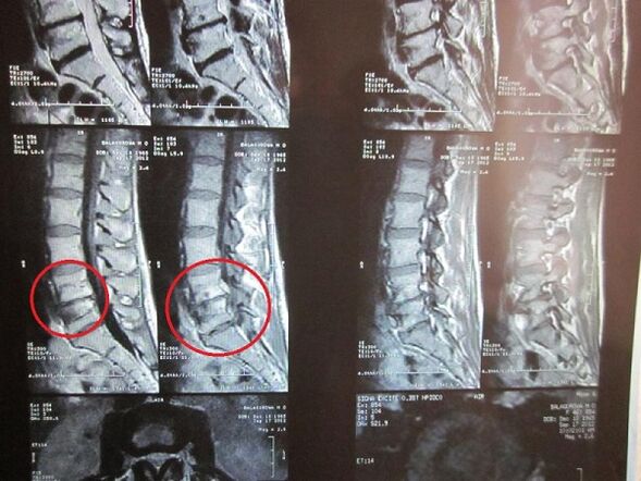 Արգանդի վզիկի օստեոխոնդրոզի ախտորոշում
