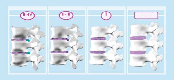 Արգանդի վզիկի օստեոխոնդրոզի փուլերը