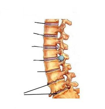 Ինչպես է զարգանում օստեոխոնդրոզը