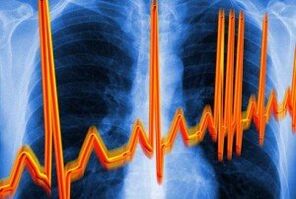 Սրտի առիթմիա օստեոխոնդրոզի համար