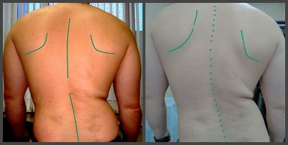 ողնաշարի կորություն օստեոխոնդրոզով