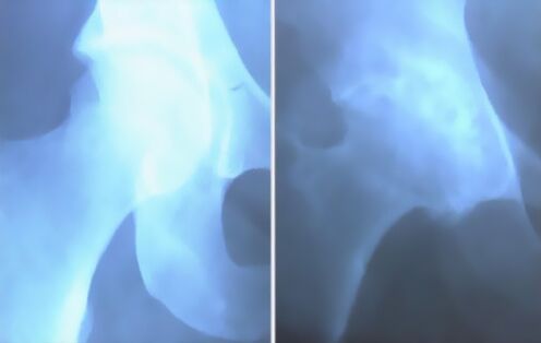 Ծնկների հոդի արթրոզային բծախնդրություն