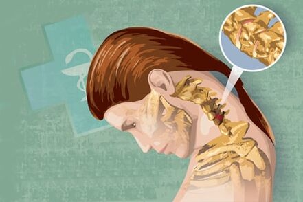 Օստեոխոնդրոզի ռեֆլեքսային ախտանիշներ